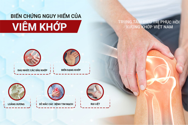  Biến chứng Viêm khớp 