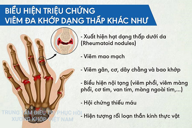 Biểu hiện triệu chứng Viêm đa khớp dạng thấp khác