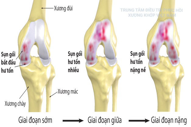 Các giai đoạn quá trình Thoái hóa khớp