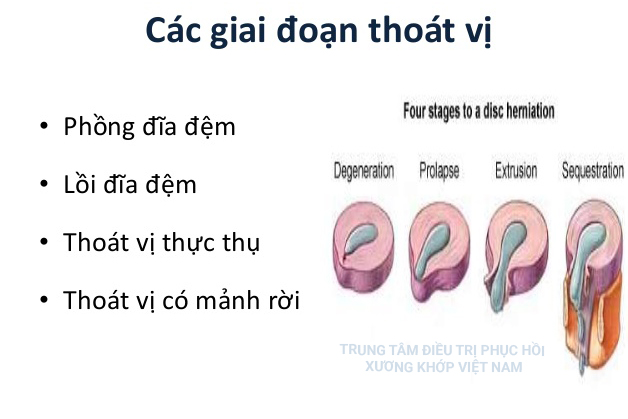 Các giai đoạn Thoát vị đĩa đệm