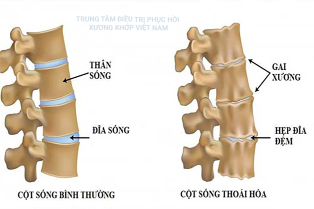 Đau bả vai, đau khuỷu tay, đau khớp bàn tay