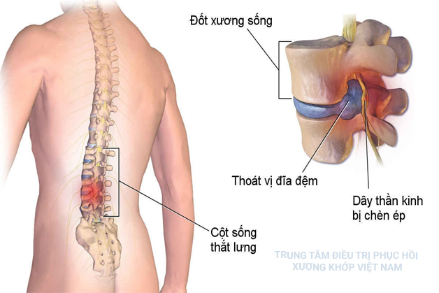 Cột sống thắt lưng, thoát vị đĩa đệm, dây thần kinh bị chèn ép