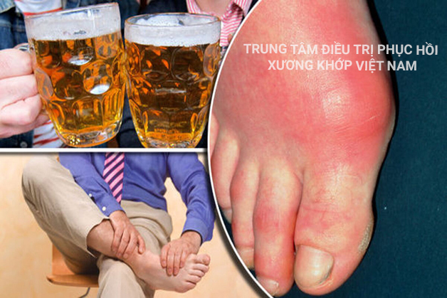 Đau khớp bàn tay, bàn chân có thể là bệnh Gout