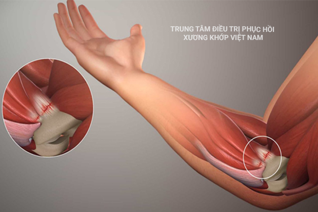 Viêm gân khuỷu tay