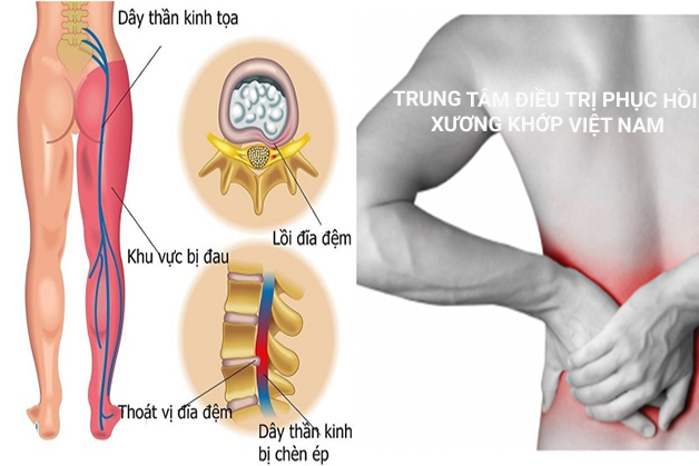 Đau lưng do thoát vị đĩa đệm gây ra