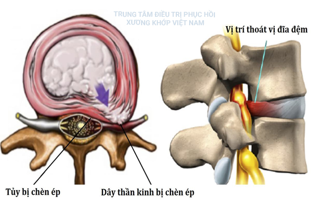  Dây thần kinh bị chèn ép