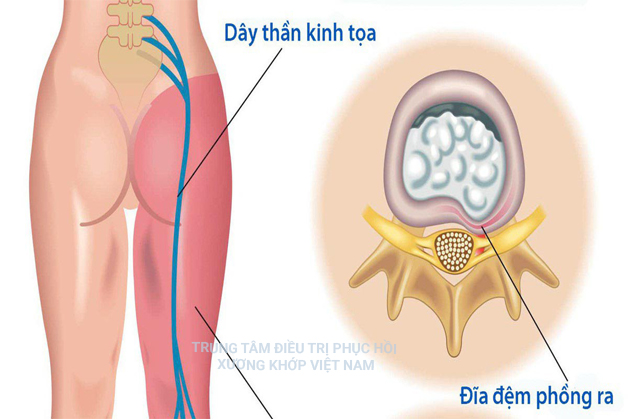 Dây thần kinh tọa, đĩa đệm phồng ra