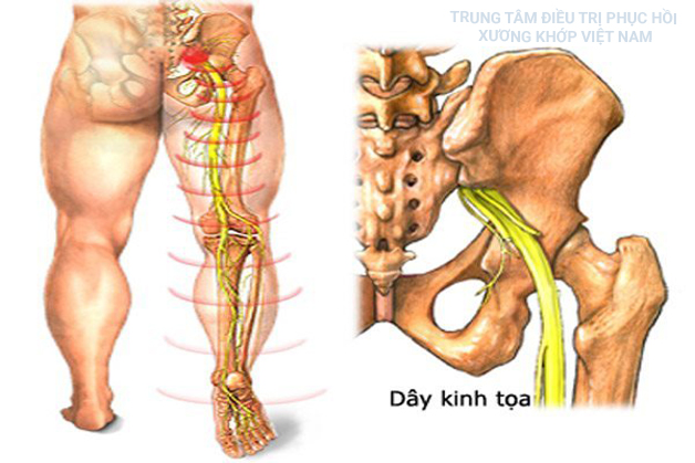 Dây Thần kinh tọa 