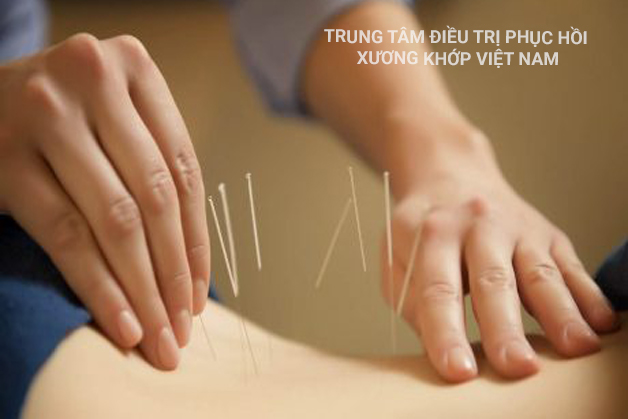 Điều trị bệnh bằng phương pháp châm cứu