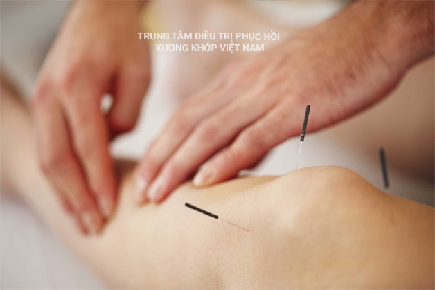 Điều trị đau đầu gối bằng Châm cứu