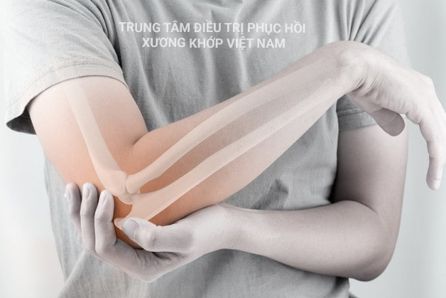 Điều trị dứt điểm đau khuỷu tay bằng Đông Y