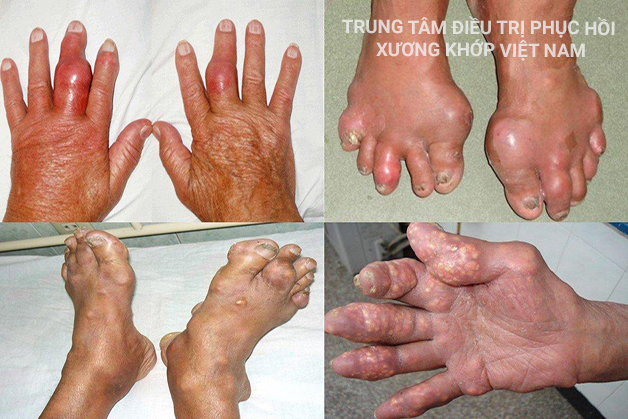Gout là bệnh nguy hiểm nếu không điều trị kịp thời