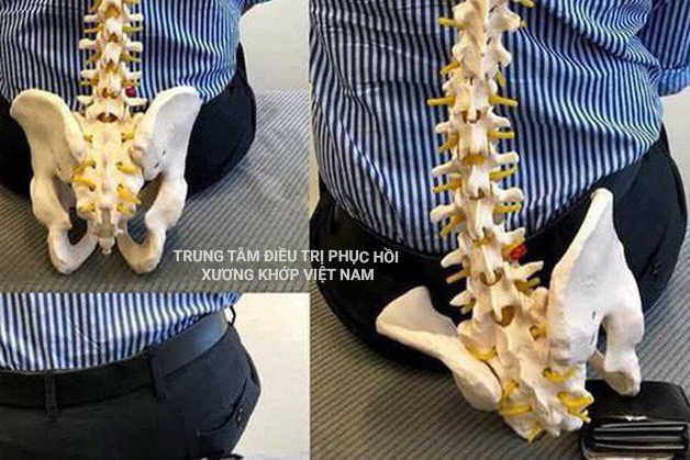 Hình ảnh cột sống cong vẹo