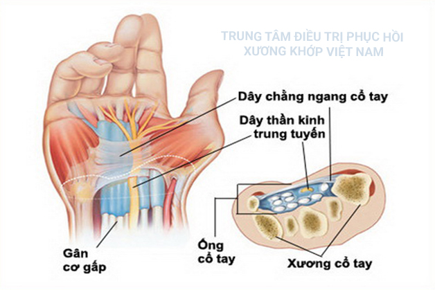 Hội chứng ống cổ tay