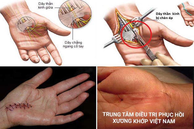 Ðiều trị phẫu thuật hội chứng ống cổ tay