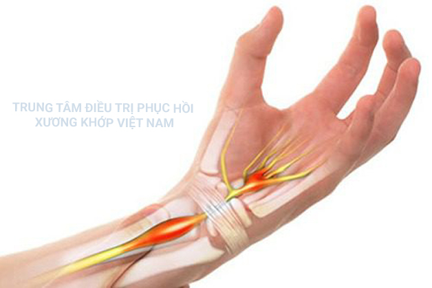 Khi ở giai đoạn nặng: Cảm giác đau nhức, tê buốt