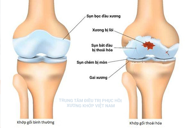 Khớp gối bình thường, khớp gối thoái hóa