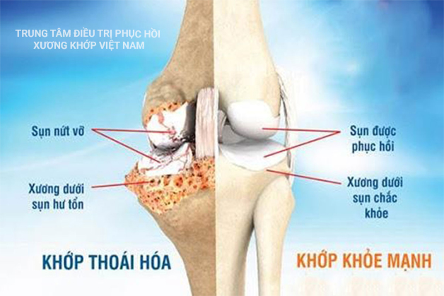 Khớp gối khỏe mạnh, khớp gối thoái hóa nặng