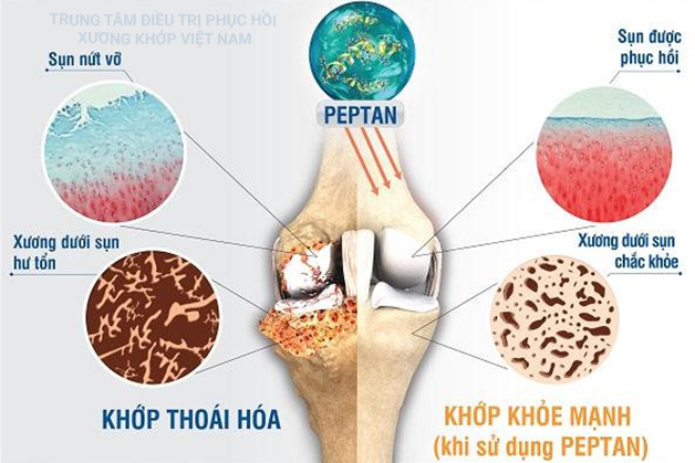 Khớp thoái hóa, khớp khỏe mạnh