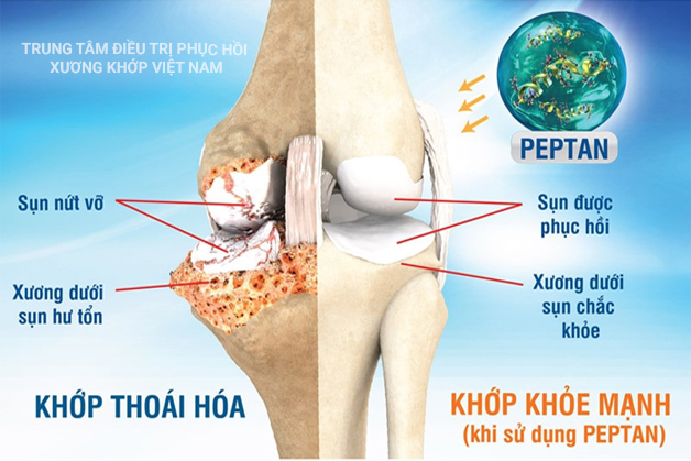 Khớp thoái hóa, khớp khỏe mạnh 