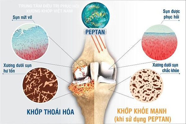 Khớp thoái hóa, khớp khỏe mạnh 