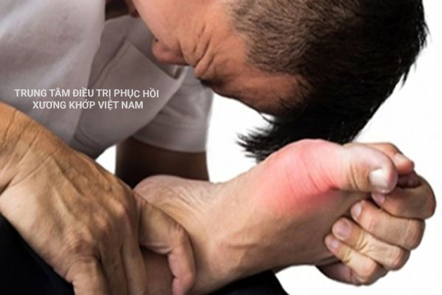 Chuyên gia giải đáp bệnh Gout có chữa khỏi được không?