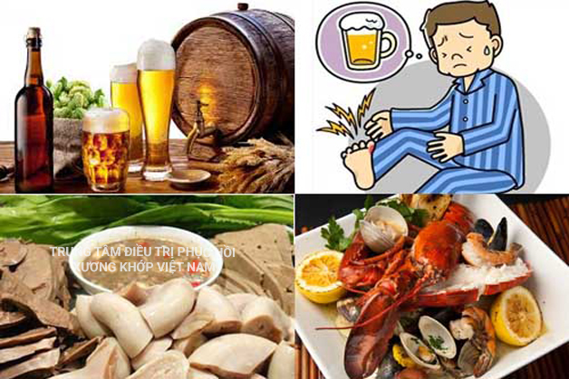 Nguyên nhân dẫn tới bệnh Gout