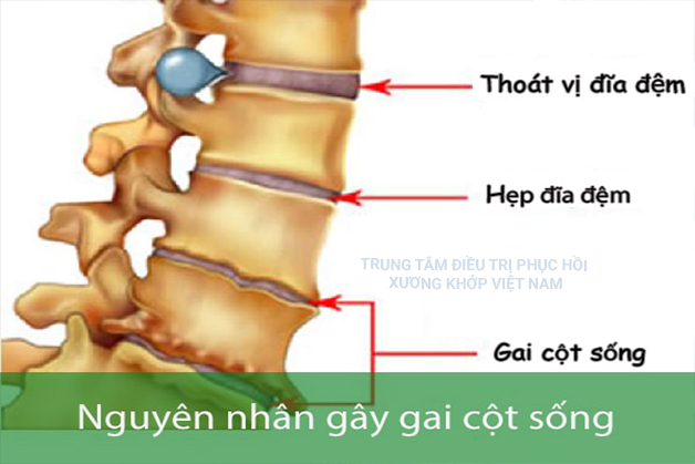 Nguyên nhân Gai cột sống