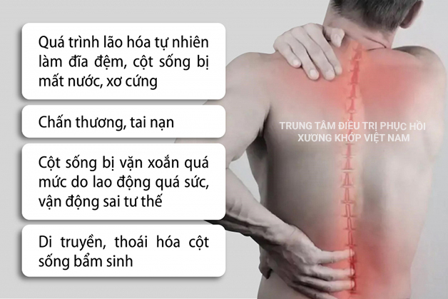 Nguyên nhân thoát vị đĩa đệm