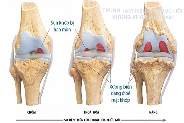 Sự tiến triển của thoái hóa khớp gối