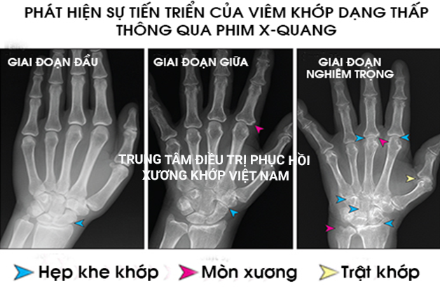 Sự tiến triển của viêm khớp dạng thấp, giai đoạn đầu hẹp khe khớp