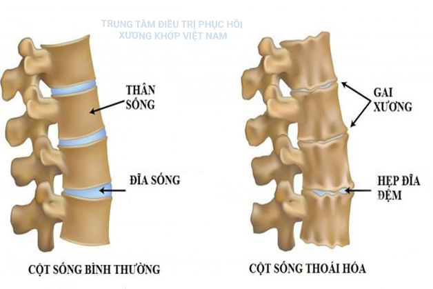 Thoái hóa cột sống thắt lưng