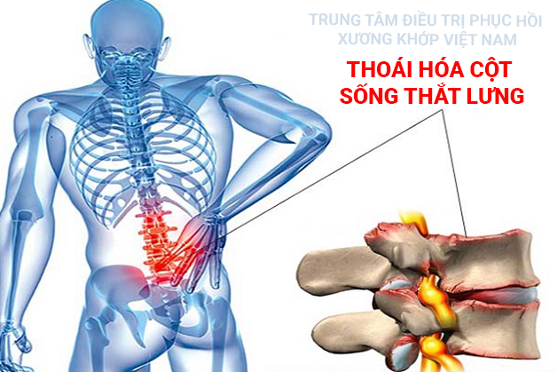 Thoái hóa cột sống thắt lưng