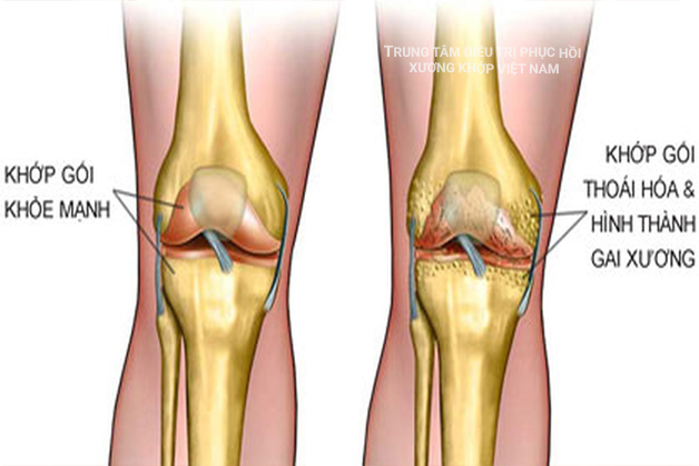 Thoái hóa khớp gối