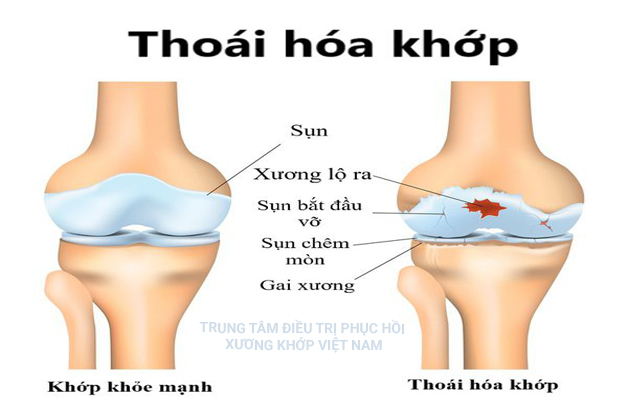 Thoái hóa khớp khiến sụn yếu đi và dễ bị nứt vỡ