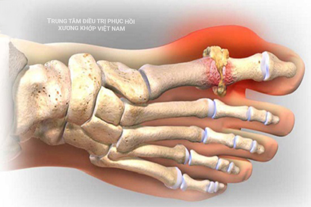 Thoái hóa khớp ngón chân