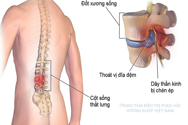 Thoát vị đĩa đệm