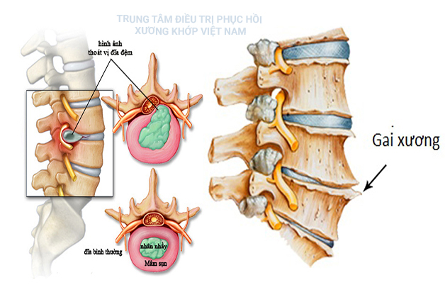 Thoát vị đĩa đệm