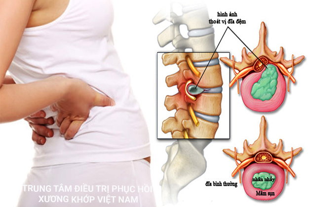 Thoát vị đĩa đệm