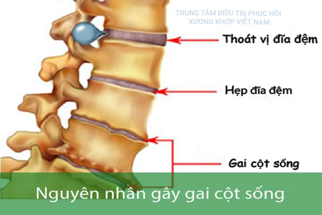 Thoát vị đĩa đệm, hẹp đĩa đệm, gai cột sống