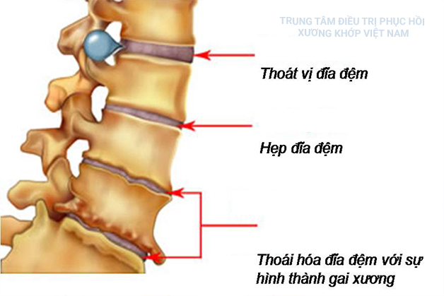 Thoát vị đĩa đệm, Hẹp khe khớp