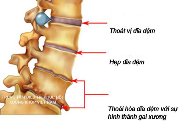 Thoát vị đĩa đệm với sự hình thành gai xương