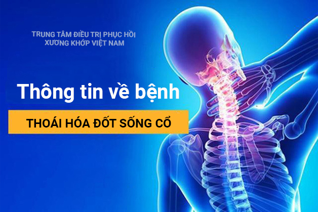 Thông tin về bệnh thoái hóa đốt sống cổ 