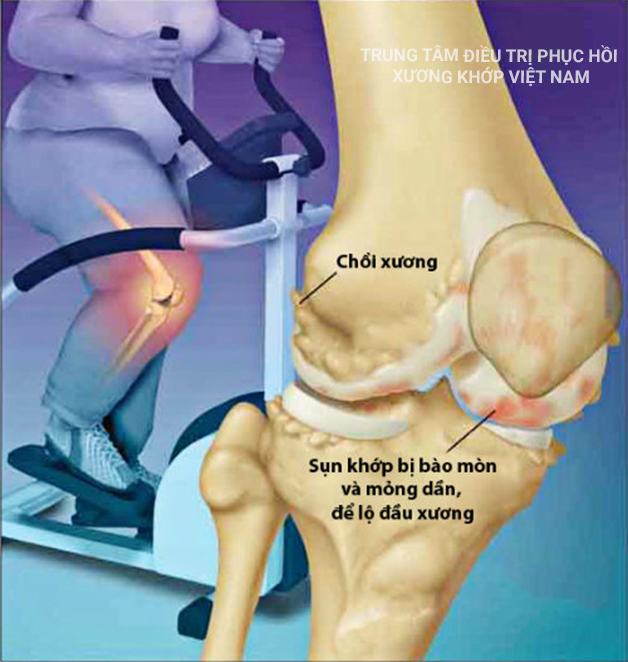 Thừa cân, béo phì cũng là yếu tố nguy cơ của tràn dịch khớp gối