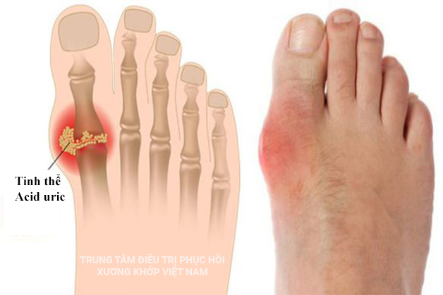 Tinh thể Axit Uric