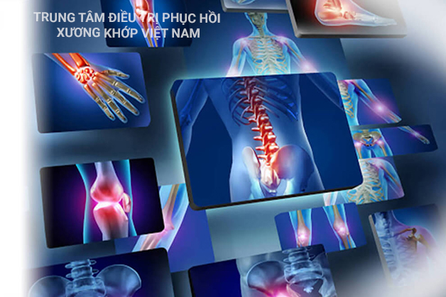 Tình trạng bệnh xương khớp tại Việt Nam