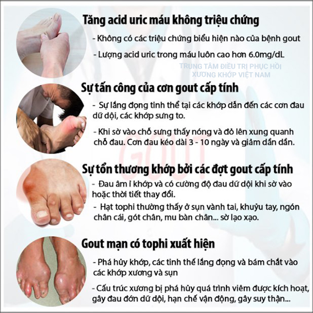 Triệu chứng bệnh Gout