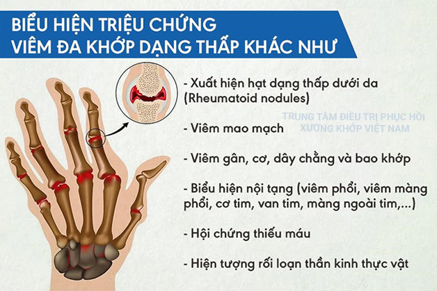 Triệu chứng Bệnh viêm đa khớp dạng thấp