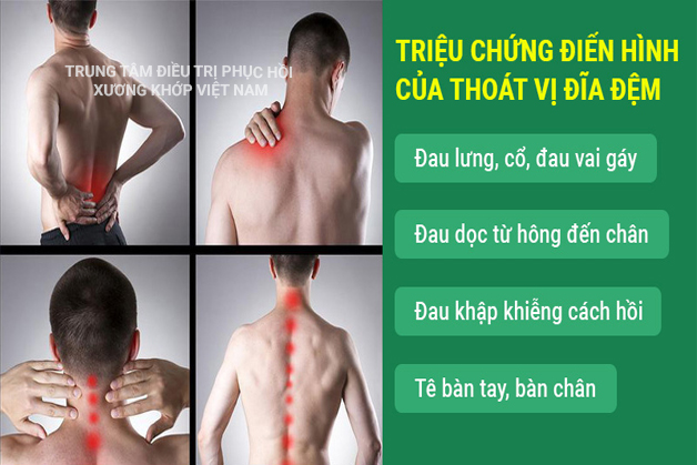 Triệu chứng của Thoát vị đĩa đệm