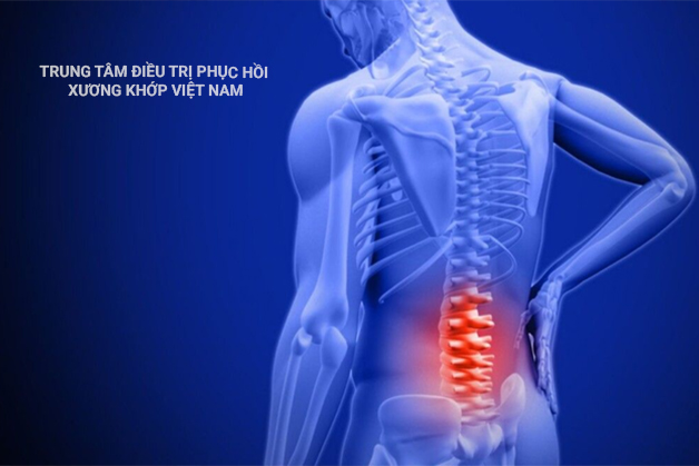 Triệu chứng Vôi hóa côt sống